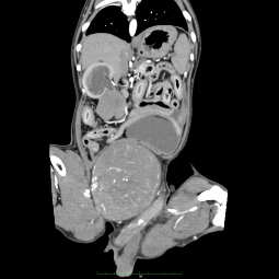 CT症例-腹腔内精巣腫瘍およびリンパ節転移を起こした症例