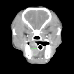 CT症例-舌裏にできた結節性筋膜炎の症例
