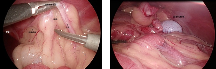 腹腔鏡による低侵襲外科手術のイメージ