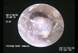 耳道の腫瘤